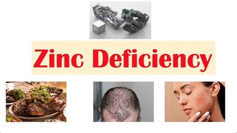 Zinc Deficiency Dietary Sources Causes Signs And Symptoms Ex Hair Free Nude Porn Photos