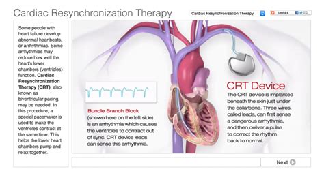 Fsi Shp Adding Cardiac Resynchronization Therapy Could Increase