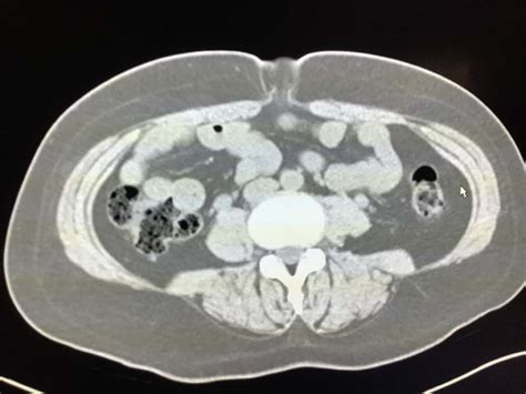 Umbilical Hernia On Ct Radiology In Plain English