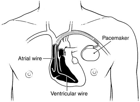 Cardiac Pacemakers From The Patients Perspective Circulation
