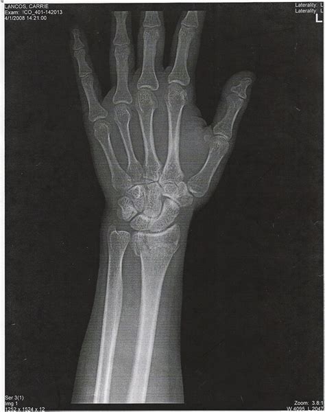Wrist X Ray 1 Front View Of My Broken Left Wrist Taken