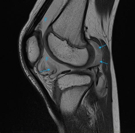 11 Juvenile Chronic Arthritis Mri Knee Mri At Melbourne Radiology Clinic