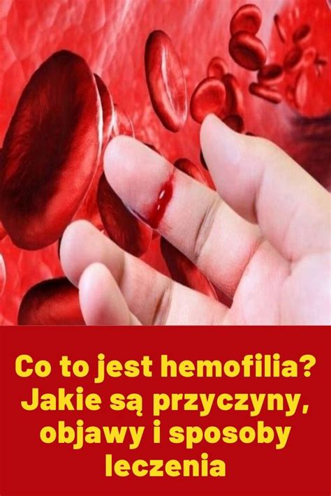 Hemofilia Krwawi Czka Objawy Przyczyny Leczenie Hot Sex Picture The