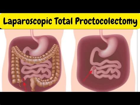 Laparoscopic Total Proctocolectomy With End Ileostomy By Dr Vipin Goel YouTube