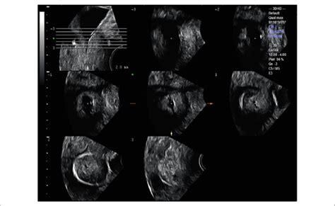 Tomographic Ultrasonographic Image Tui Axial Slices Through The