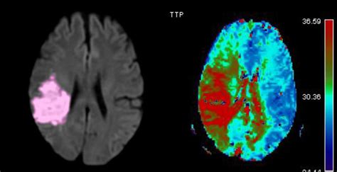 Mri Perfusion Diffusion Mismatch The Small Lesion On Download