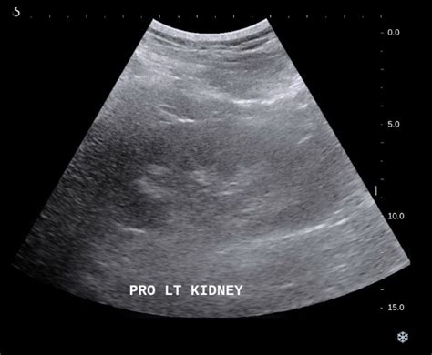 Interventional Radiology Procedures Ultrasound Guided Non Focal Renal