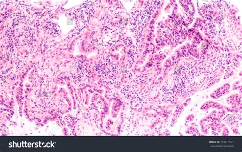 Photomicrograph Lung Biopsy Showing Pulmonary Adenocarcinoma Stock