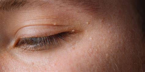 Milia Under Eyes Causes Treatment Prevention Ph