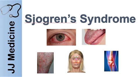 Sjogrens Syndrome Dry Eye Syndrome Primary Vs Secondary