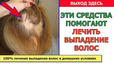 Лечение выпадения волос у женщин в домашних условиях