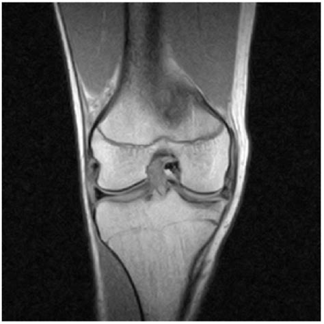 Coronal Mri Of The Right Knee Revealing Intra Articular Open I