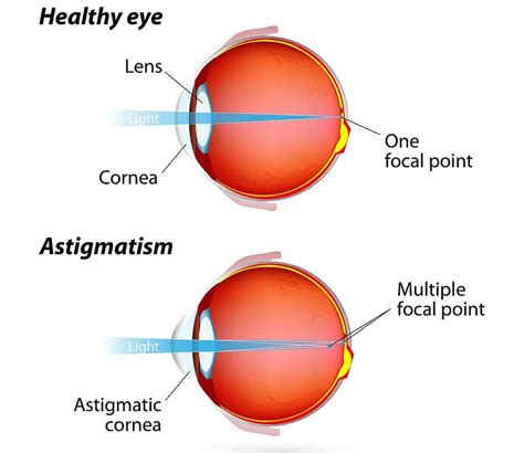 Cataract Surgery And Irregular Astigmatism Ic 8 Lens