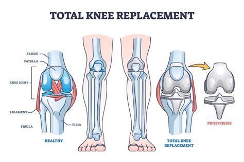 Types Of Knee Replacement Surgery In The Uk The Best Of Health
