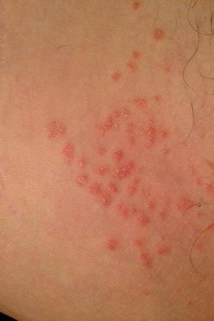 Haven't tried a steroid cream or any meds yet. inner arm rash - pictures, photos