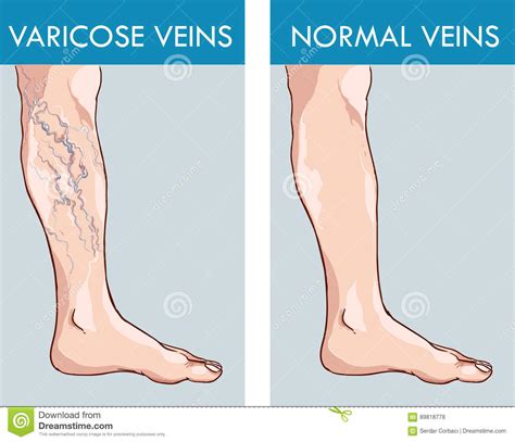 Illustration Of A Healthy Leg And The Affected Varicose Veins Stock