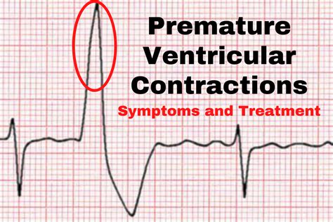 Premature Ventricular Contractions Pvcs Symptoms Causes Diagnosis
