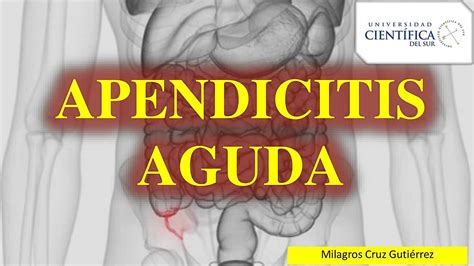 Apendicitis Aguda Score De Alvarado Pierodiaz Med Apendicitis Apendicitis Aguda Udocz Kulturaupice