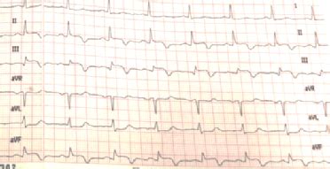 ST Elevation in a COVID-19 Positive Patient
