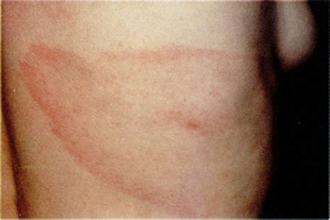 European Erythema Migrans Disease And Related Disorders Open I