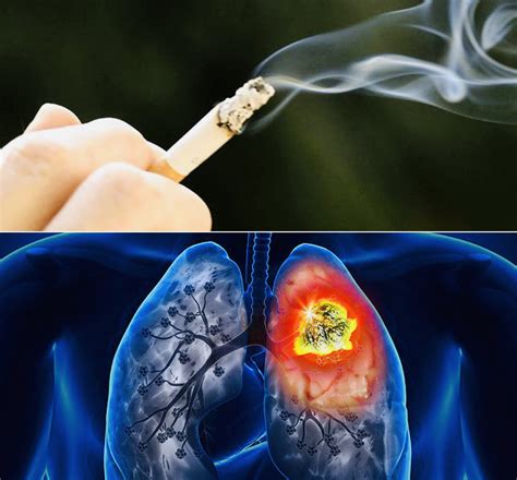 Không hút thuốc vẫn mắc ung thư phổi: Vì sao?