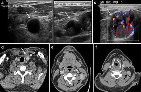 Thyroid Computed Tomography Imaging Pictorial Review Of Variable