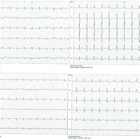 Twelve Lead Electrocardiogram 5 Mmmv At Presentation A Shows Sinus