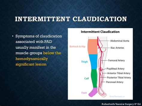 Topic Of Vascular Claudication