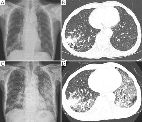 Small Cell Lung Cancer Presenting As Fatal Pulmonary Hemorrhage