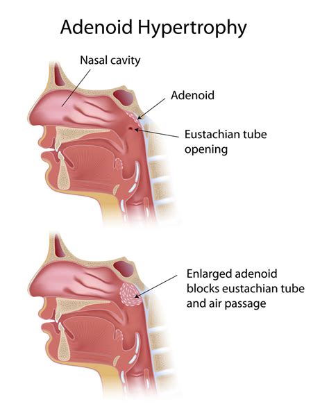 Adenoid And Adenoidectomy Otolaryngology Specialists Of North Texas