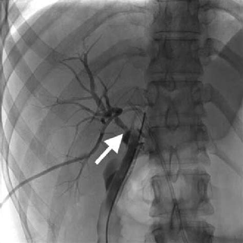 Percutaneous Transhepatic Cholangiogram Demonstrating The Site Of Leak