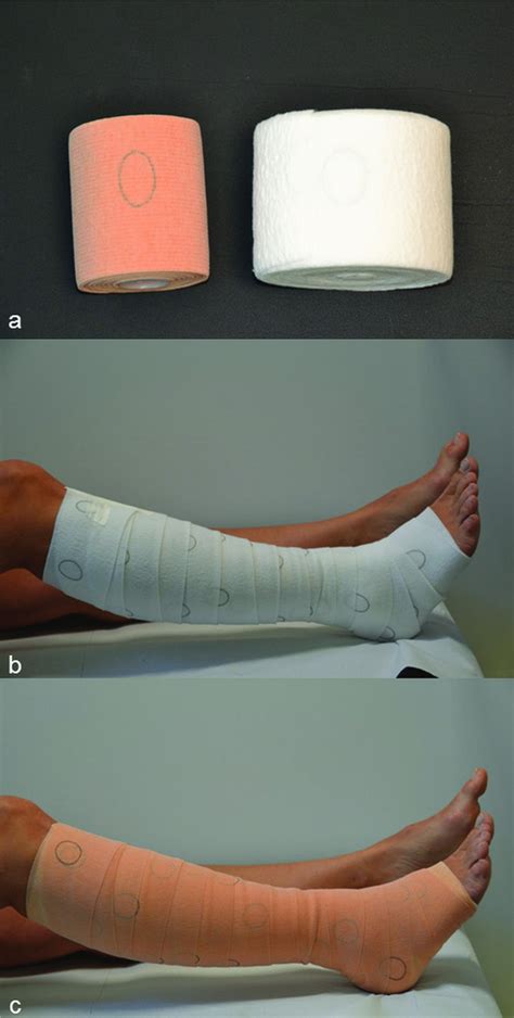 Compression Therapy In Patients With Venous Leg Ulcers Dissemond