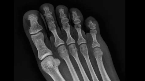5th Toe Fracture Xray 40 Youtube