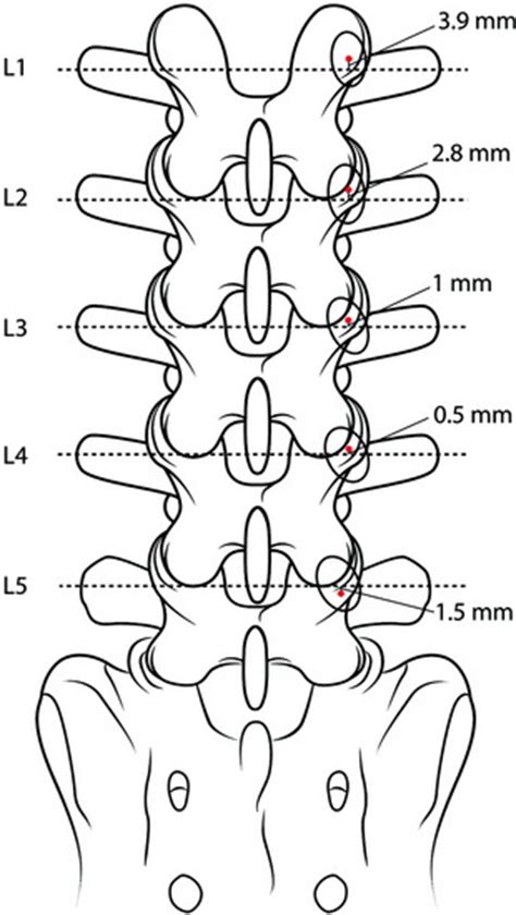 Posterior Lumbar And Lumbosacral Junction Stabilization Neupsy Key