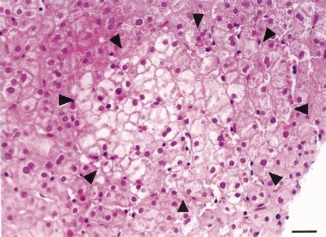 A Clear Cell Focus In A Liver Biopsy Taken From A Patient With Chronic