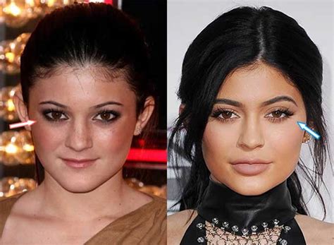 Kylie Jenner Before And After Nose Job Lip Injections Breast