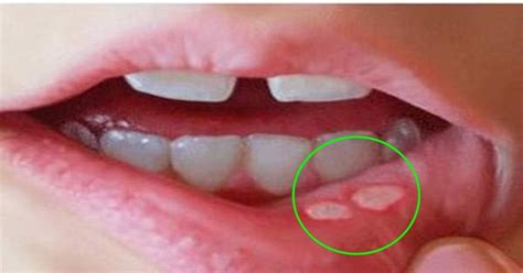 How To Get Rid Of Canker Sore Mouth Ulcers Naturally At Home