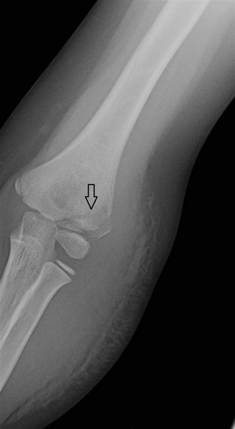 Lateral Humeral Condyle Fracture Page Of Journal Of Urgent Care