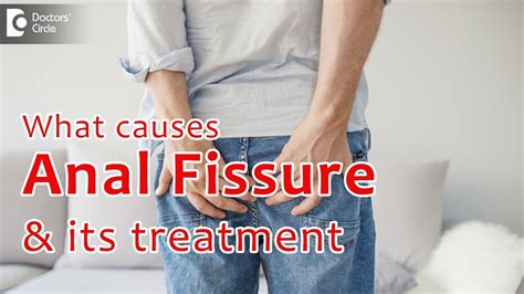 Anal Fissure Causes And Treatment Dr Govind Nandakumar Youtube