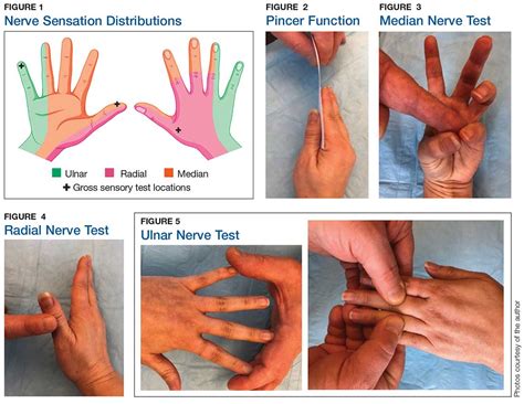 Median Nerve Palsy