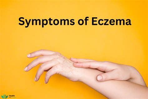 Eczema Symptoms And Treatment