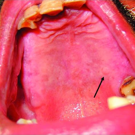 Intraoral Picture Showing The Adenomatoid Hyperplasia On The Hard