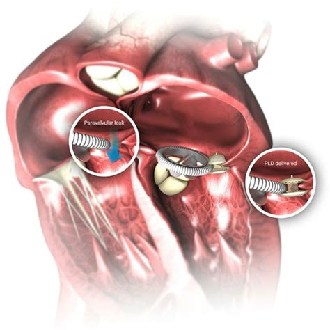 Paravalvular Leak Closure London Mitral Clinic