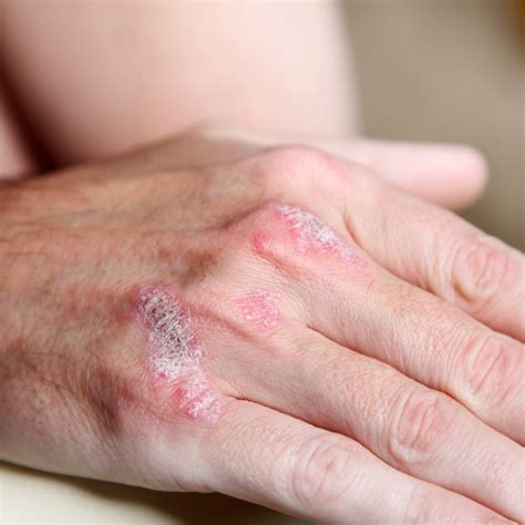 All You Need To Know About Scabies And Its Treatment Drscabies Sexiz Pix