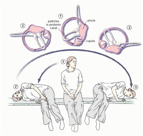 Epley Maneuver Patient Instructions Gif
