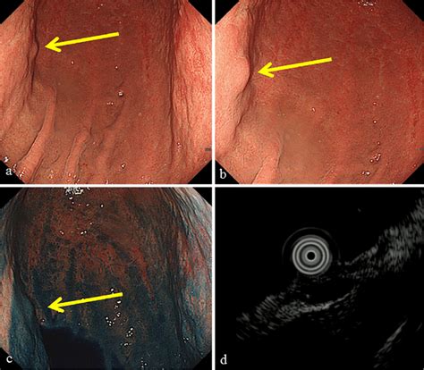 Figure1findings Of Egd And Eus A Egd Revealed A 10 Mm Submucosal