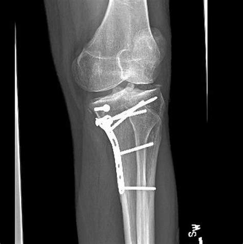Fractured Tibia And Fibula Broken Lower Leg Bones With Fixation