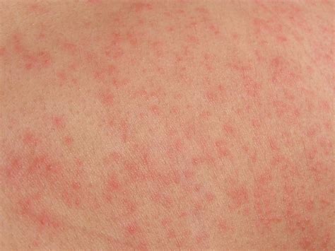 Red Dots On Skin Rash