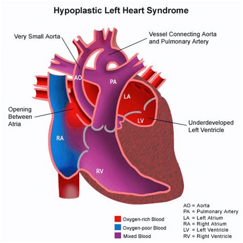 Hypo Plastic Left Heart Syndrome 1 Download Scientific Diagram