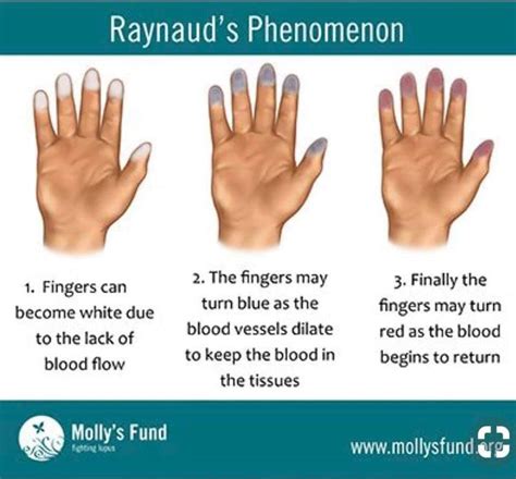 Pin by Kristina Monroe on Lupus and such | Raynauds, Raynaud's disease
